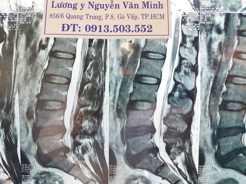 Thuốc trị bệnh thoát vị đĩa đệm, em uống 20 thang hết nhức rồi thầy!