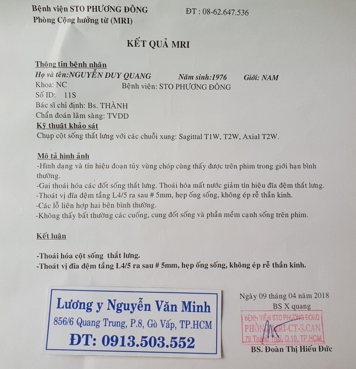 Thoát vị đĩa đệm thắt lưng