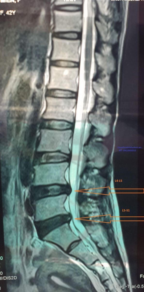 Thoát vị đĩa đệm L4 L5, L5 S1
