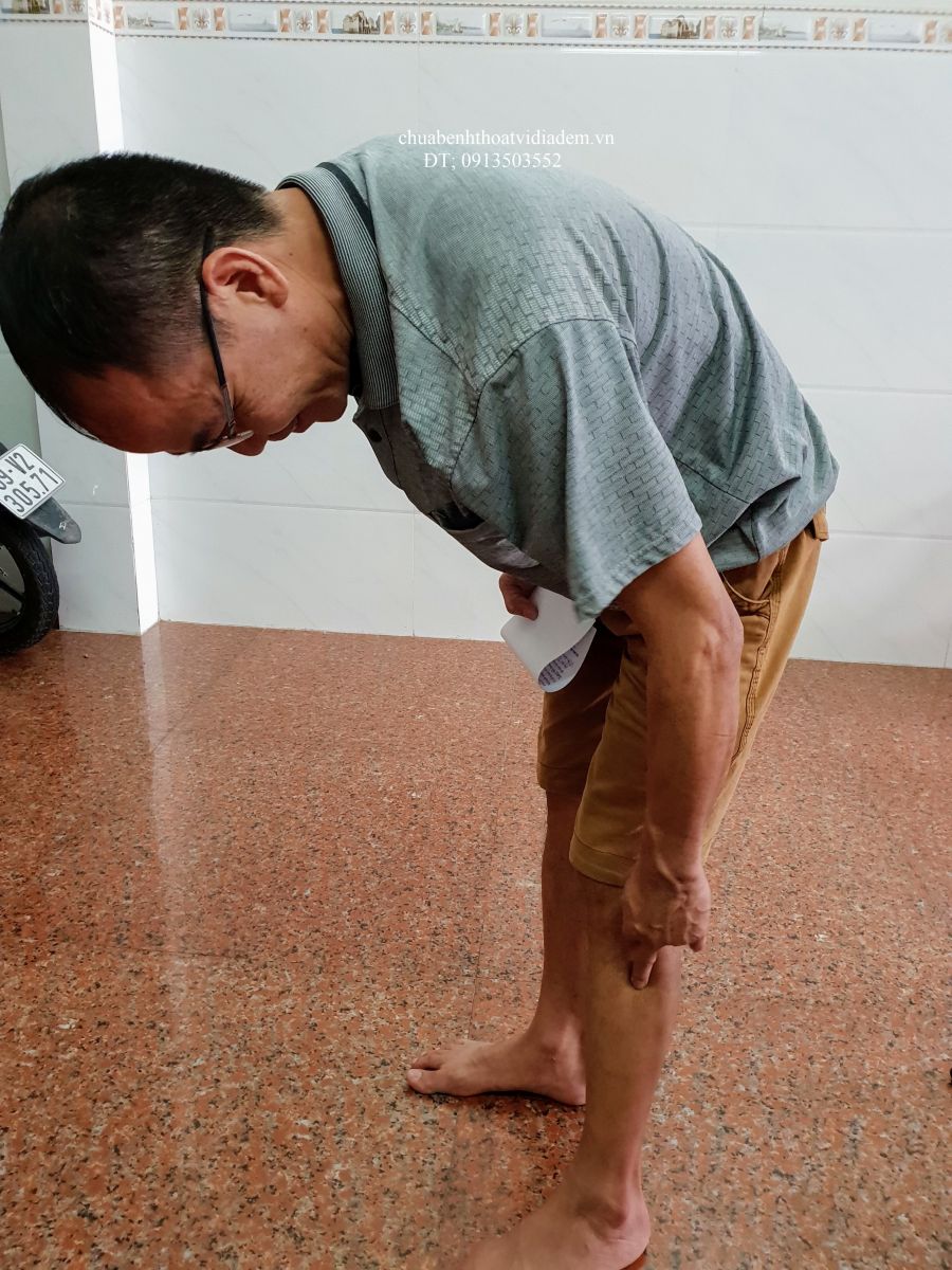 Thoát vị đĩa đệm thắt lưng