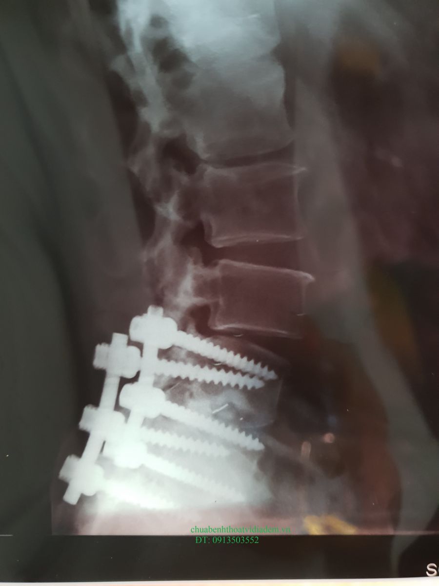 Mổ thoát vị đĩa đệm