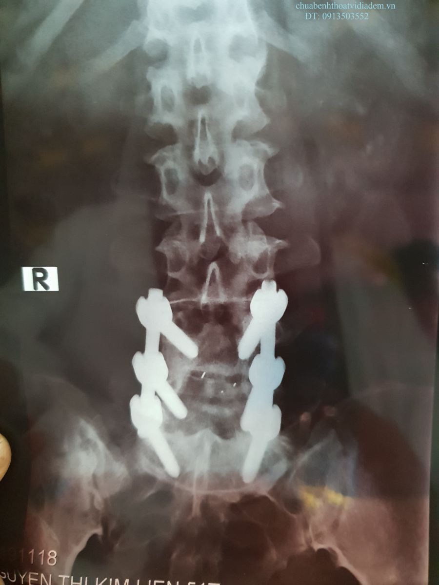 Hình ảnh mổ thoát vị đĩa đệm