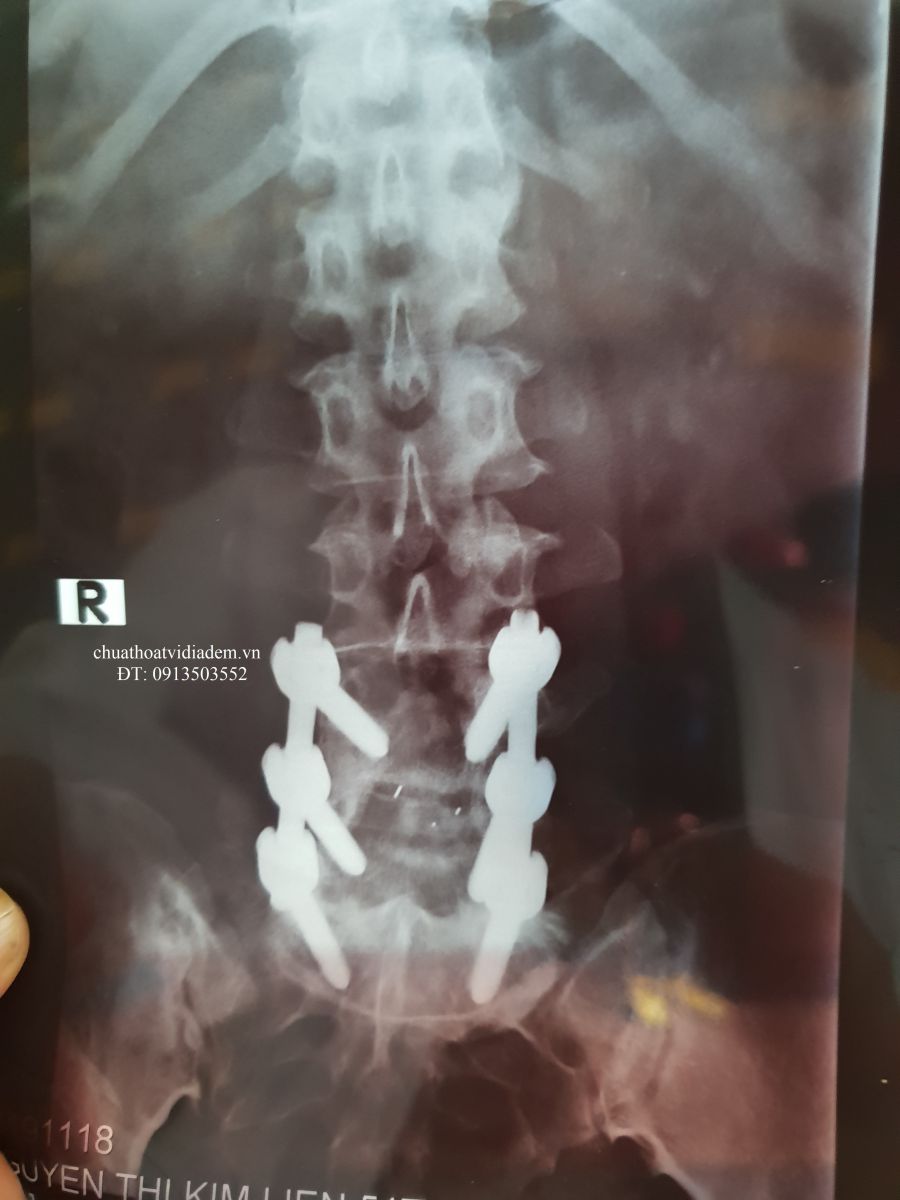 Mổ thoát vị đĩa đệm ở bệnh viện Chợ Rẫy