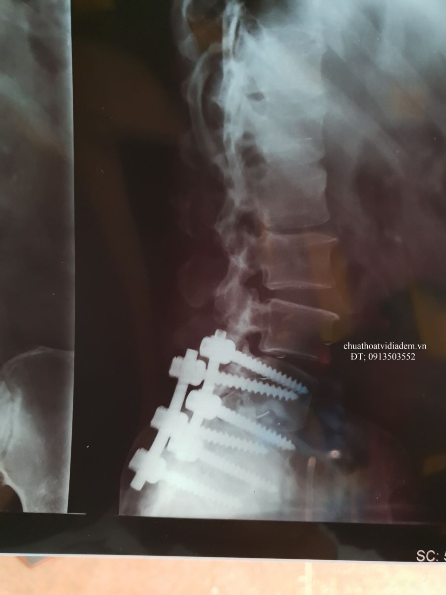 Phẫu thuật thoát vị đĩa đệm