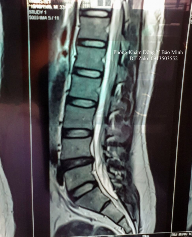 chụp cộng hưởng từ cột sống thắt lưng