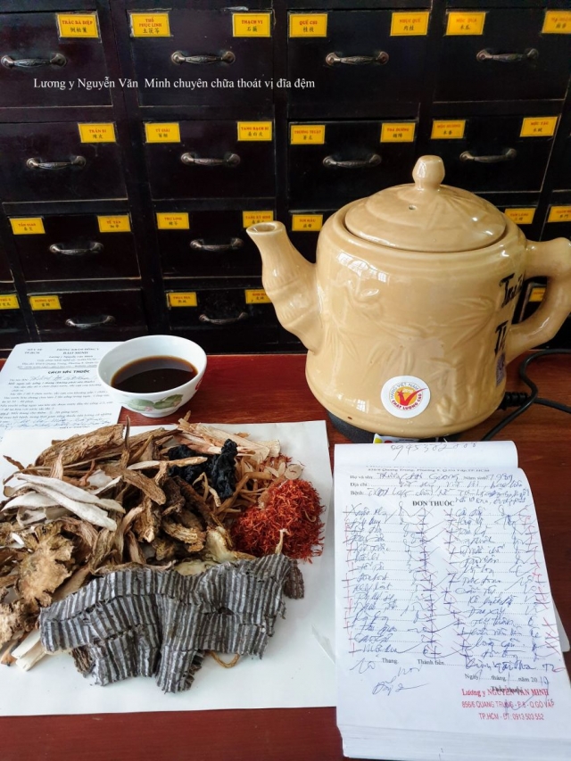 Thoái hóa đĩa đệm mất nước và lồi đĩa đệm gây hẹp ống sống, chèn ép rễ thần kinh L4, L5