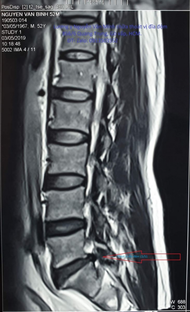Chụp cộng hưởng từ (chụp MRI) ở TP. HCM