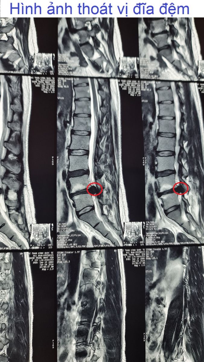 Hình ảnh thoát vị đĩa đệm