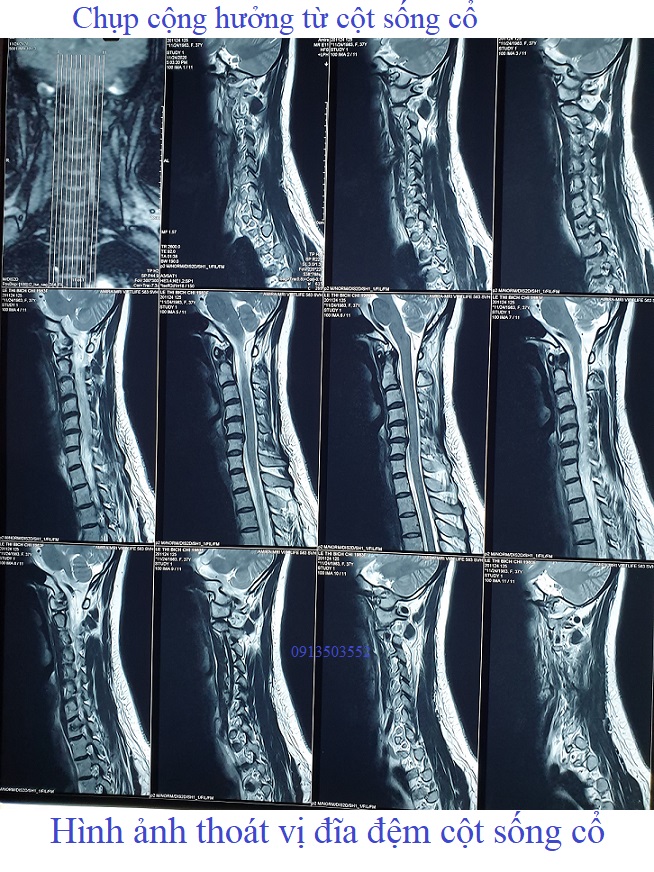 Hình ảnh thoát vị đĩa đệm