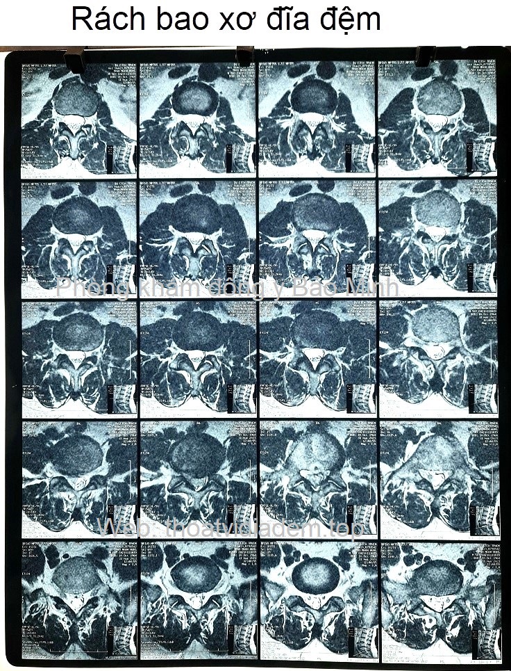 Rách bao xơ đĩa đệm 