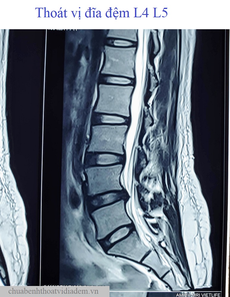 Thoát vị đĩa đệm cột sống thắt lưng L4/L5 - Xem cách trị hết bệnh của Lương y trên 20 năm kinh nghiệm.