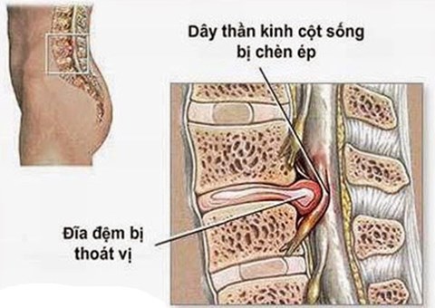 Lương y Nguyễn Văn Minh chữa thoát vị đĩa đệm cho anh Út ở Đồng Tháp, khỏi dứt tới nay.