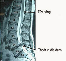 Chữa bệnh thoát vị đĩa đệm