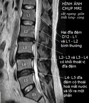  Chụp cộng hưởng từ cột sống thắt lưng