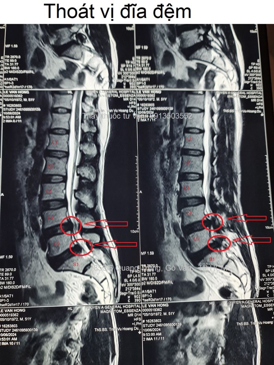 Thoát vị đĩa đệm
