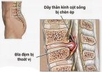 Thoát vị đĩa đệm là gì?