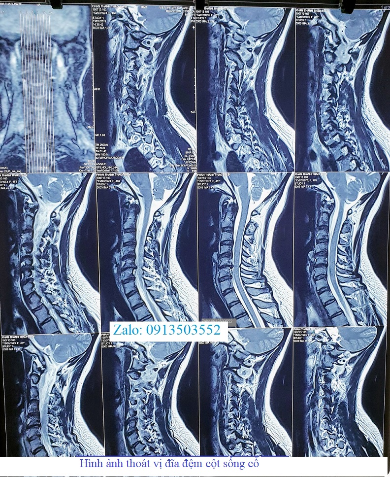 Hình ảnh thoát vị đĩa đệm cổ