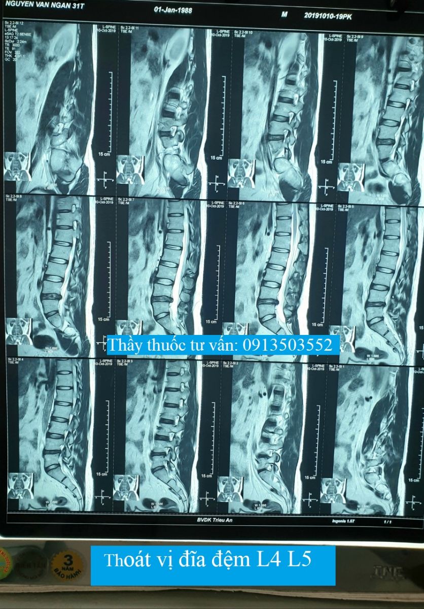 Thoát vị đĩa đệm có chữa khỏi được không