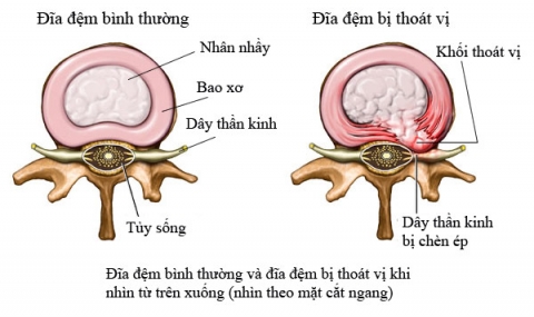 Điều trị thoát vị đĩa đệm cột sống thắt lưng; dùng cách nào an toàn mà hiệu quả nhất.